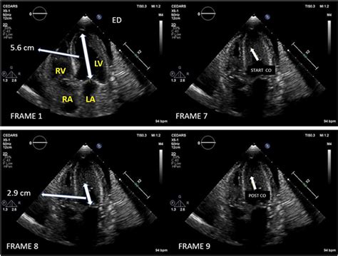 lv intracavitary gradient|intracavitary gradient echo.